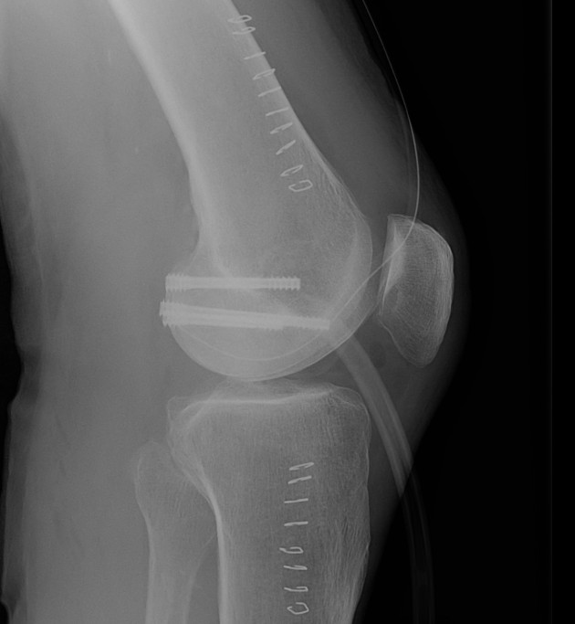 Hoffa Fracture ORIF PA screws
